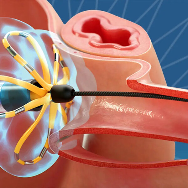 #PODCAST Experts praise a minimally invasive procedure to treat atrial ...