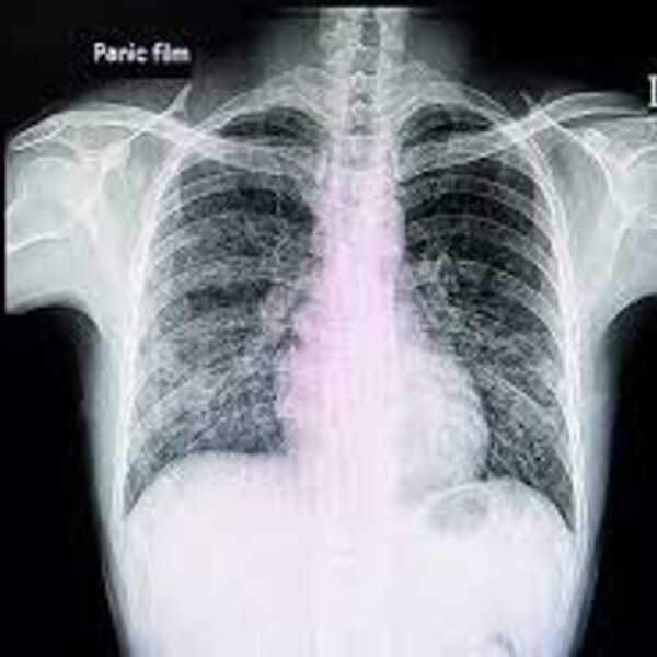 Serious lung diseases caused by dust exposure The Queensland Briefing